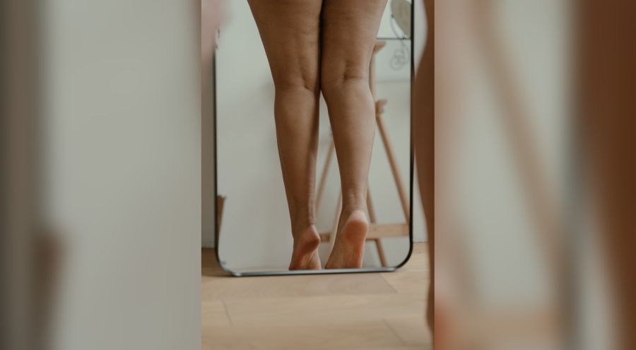 Lipedema