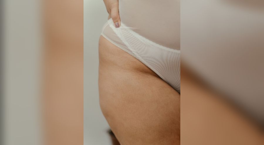 Lipedema