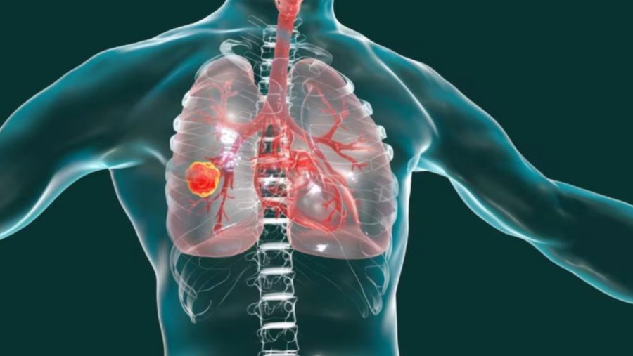 adenocarcinoma pulmonar