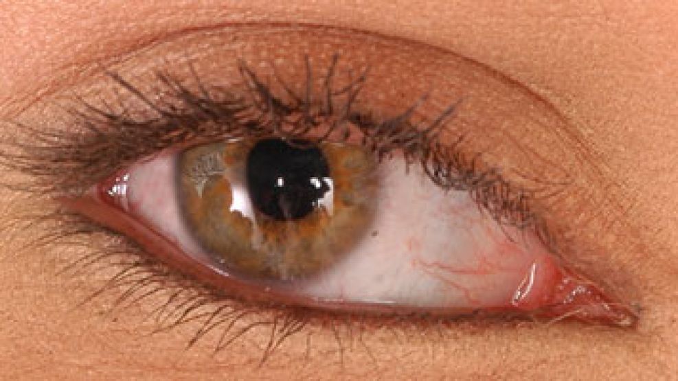 La celulitis orbitaria es una inflamación e infección de los tejidos que comprometen al ojo.