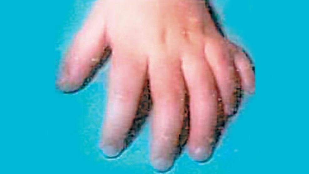 Foto de la mano de un niño con polidactilia atendido en el Garrahan.