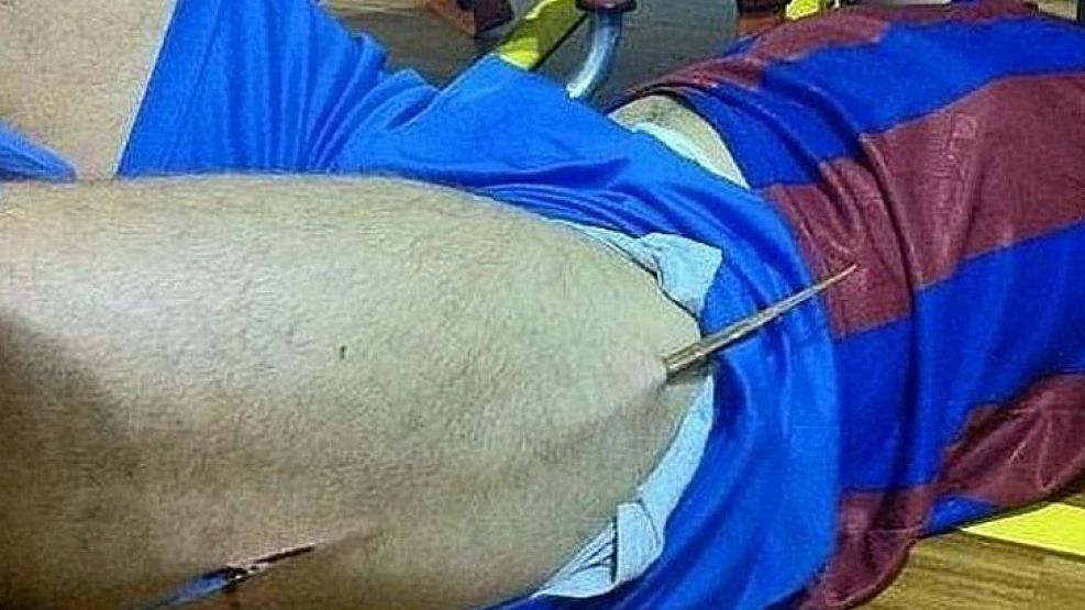Un jugador español de fútbol de salón se clavó en su muslo una astilla de 40 centímetros tras ir a buscar una pelota. Por suerte fue solamente un susto.