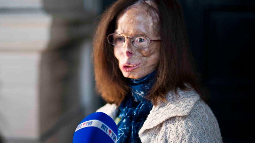 Patricia Lefranc, de 46 años, se sometió a 80 intervenciones quirurgicas para sanar su rostro