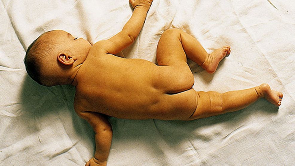 El calor del verano hace que la piel se humedezca muy fácilmente provocando irritaciones y la aparición de dermatitis. 