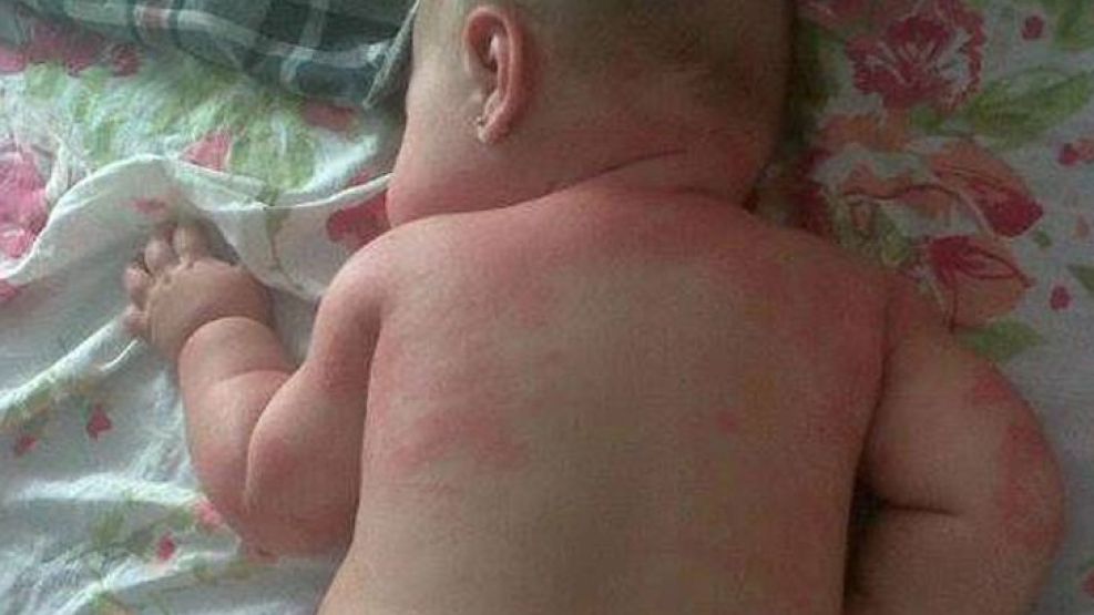 Una madre santafesina difundió por redes sociales el caso de su beba, Martina, afectada por el uso del protector solar. 