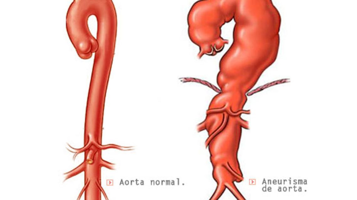 Как лечится аорта. Аневризматическое расширение грудного отдела аорты. Аневризмы сосудов, аорты, сердца. Аневризма брюшной отдел аорты отделы. Аневризма грудной аорты анатомия.