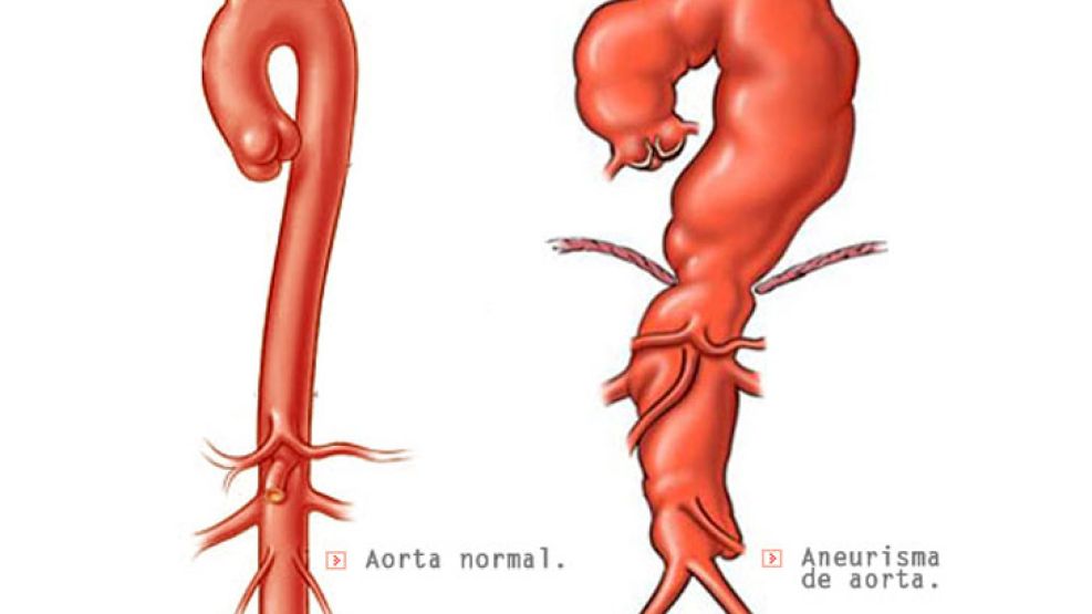 El aneurisma de aorta es una dilatación anormal o patológica de la principal arteria del corazón. 