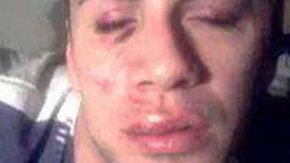 A Adrían Ramos le deformaron la cara a causa de los fuertes golpes que le propinaron.