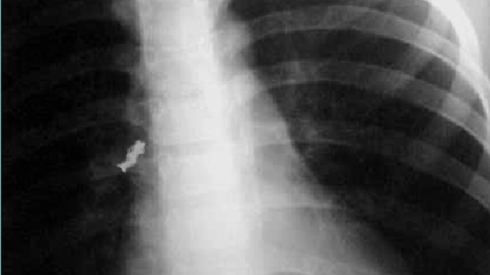 Secuelas. Un muñequito tragado por un niño, con rayos X.
