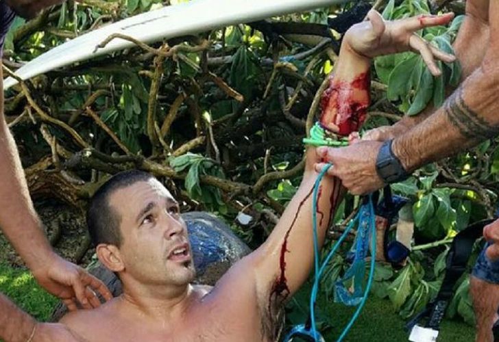 Federico Jaime, el surfer argentino atacado por un tiburón.