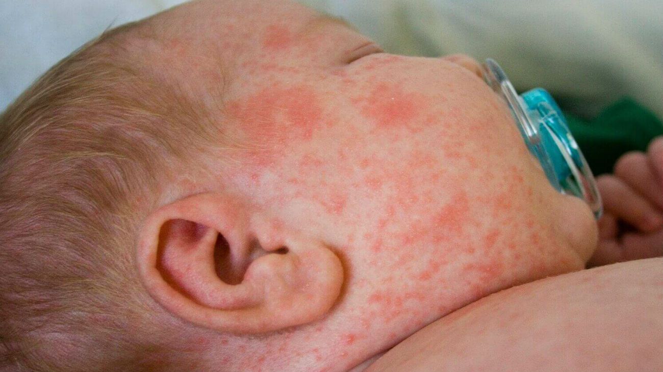 El sarampión es una enfermedad viral altamente contagiosa