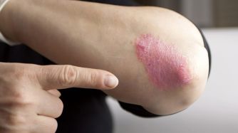 psoriasis 10262018