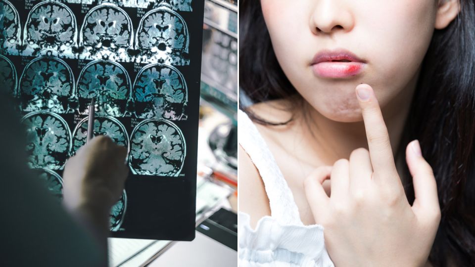 Una reciente investigación sostiene que el virus responsable de la aparición del herpes labial, también puede causar Alzheimer.