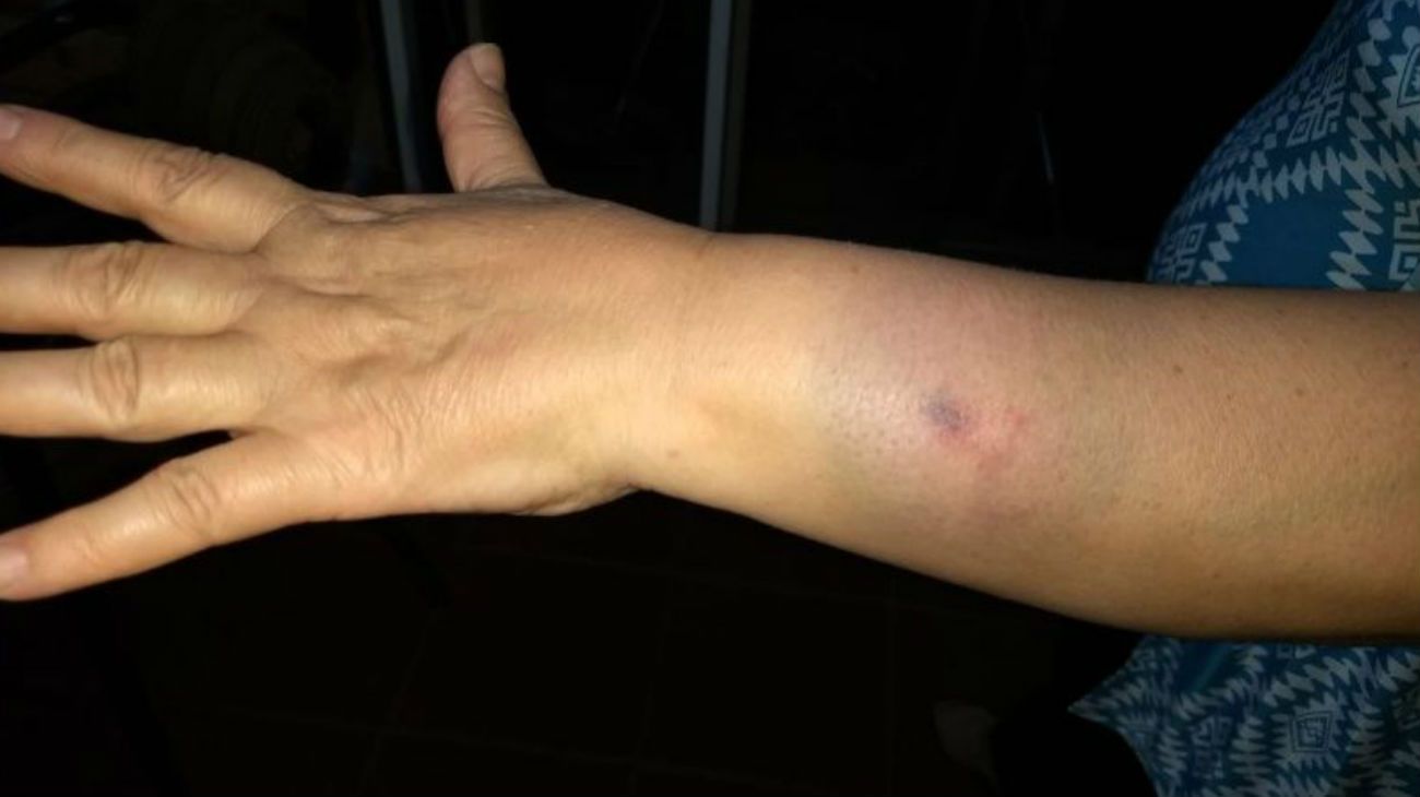 El brazo de la médica atacada por la paciente. 