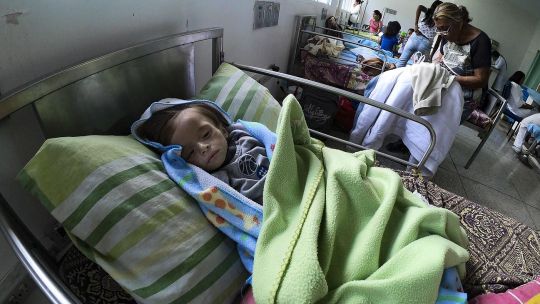 Maracay. Un niño de un año y tres meses con desnutrición.