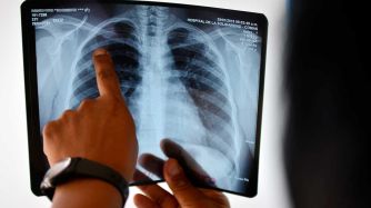 Tuberculosis 22032019