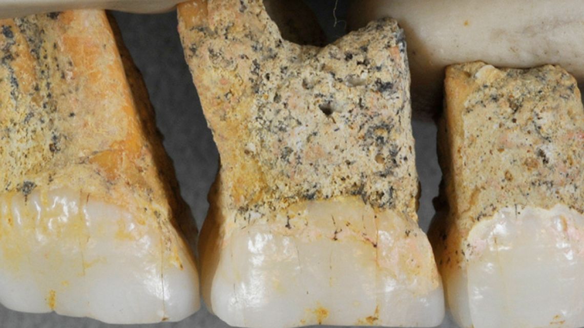 This undated photo provided by the Callao Cave Archaeology Project in April 2019 shows the right upper teeth of the individual CCH6 of the newly discovered species Homo luzonensis. 