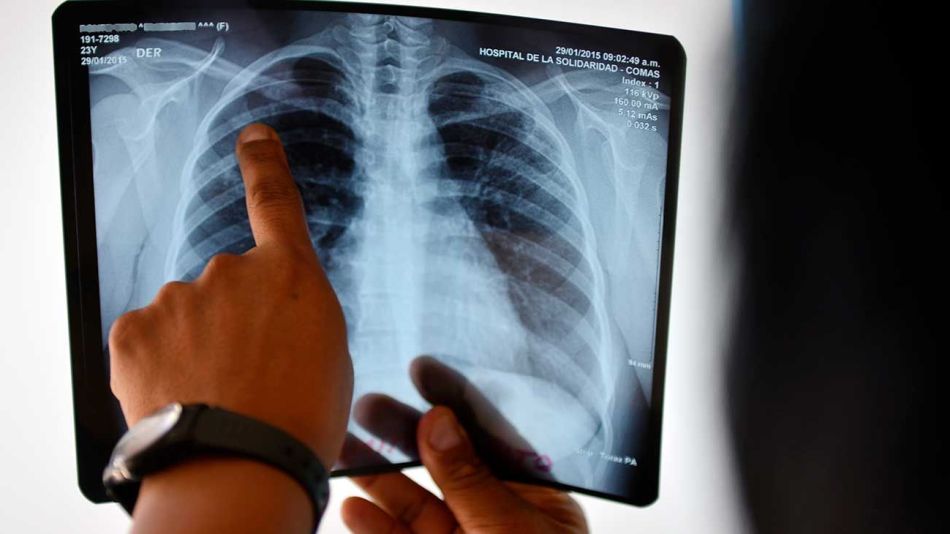 Tuberculosis