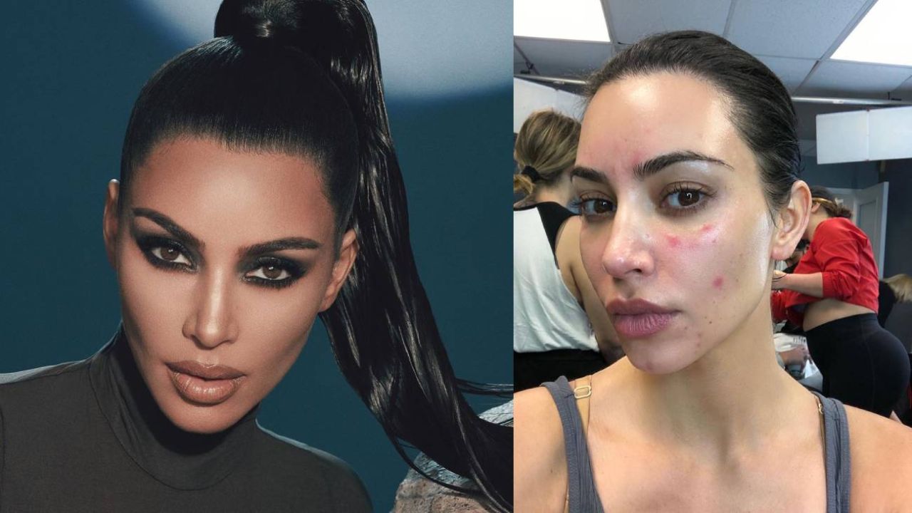 Kim Kardashian mostró las manchas de Psoriasis de su rostro | Caras