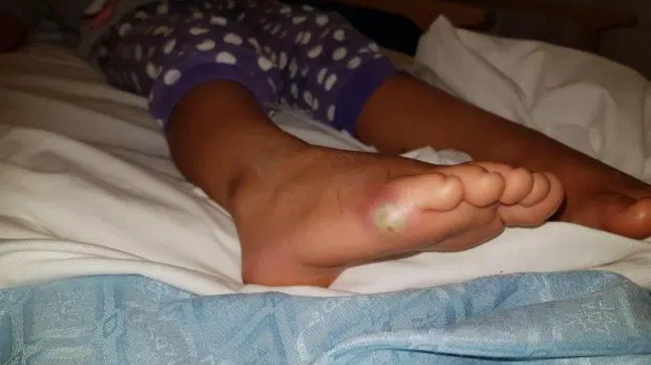 El pie de la pequeña de 4 años con la infección. 