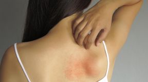 psoriasis 20191024
