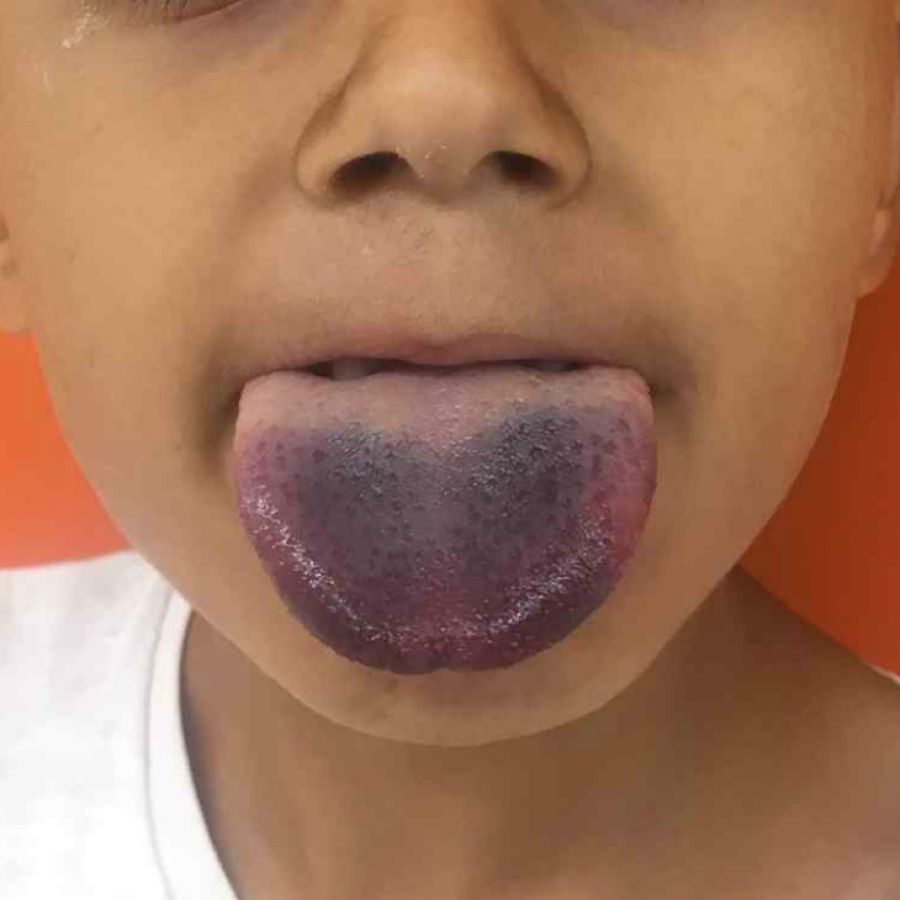 Un Medico Uso Un Viejo Truco Para Liberar La Lengua De Un Nino Atrapada En Una Botella Perfil