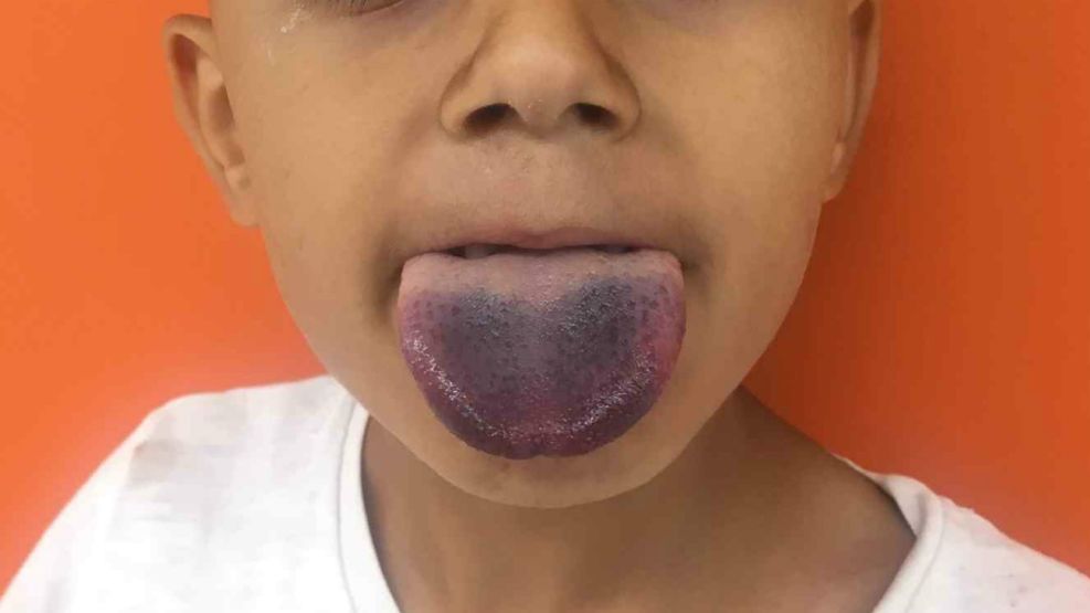 El niño quedó varias horas con la lengua morada