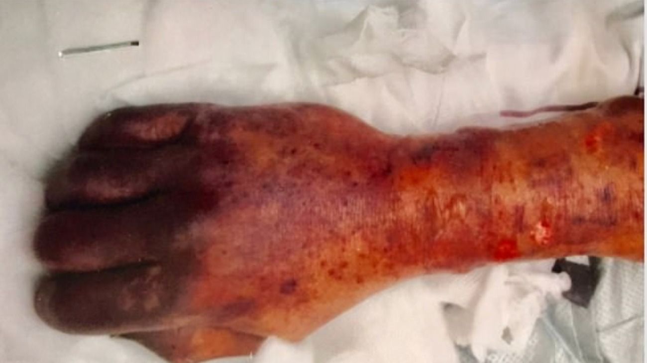 Así quedó la mano del hombre que fue lamido por su perro y éste le transmitió una bacteria que lo mató.