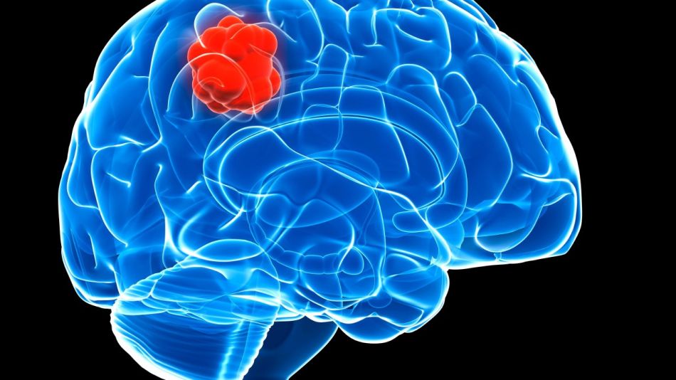 Glioblastoma Bonadio