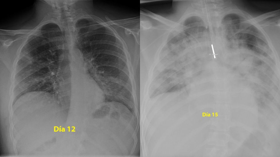 pulmones