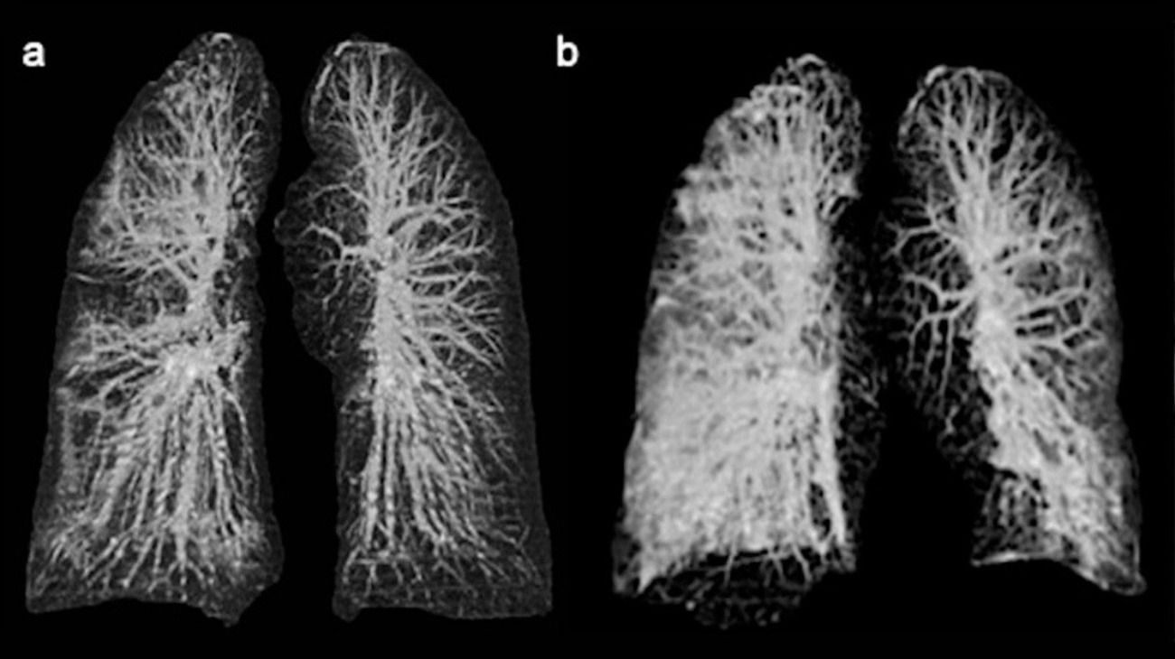 Cómo se ven los pulmones de los pacientes que tienen coronavirus