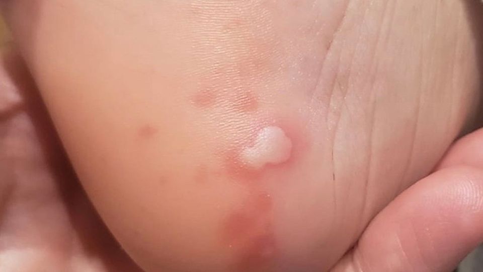 Lesiones acrales producidas por la Covid-19.