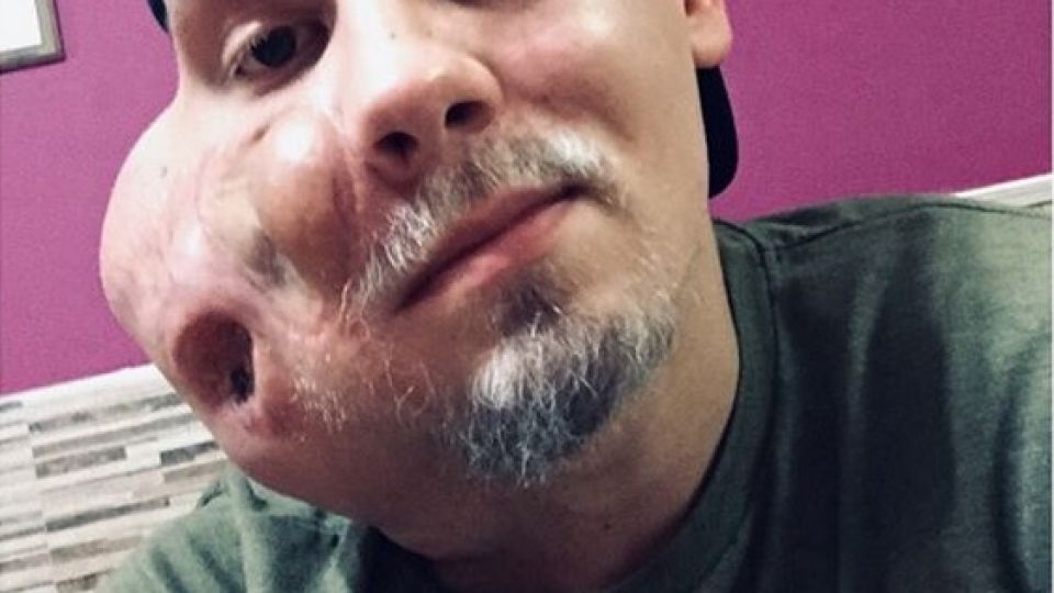 Sebastián D'Amico tiene 23 años y padece un extraño cáncer