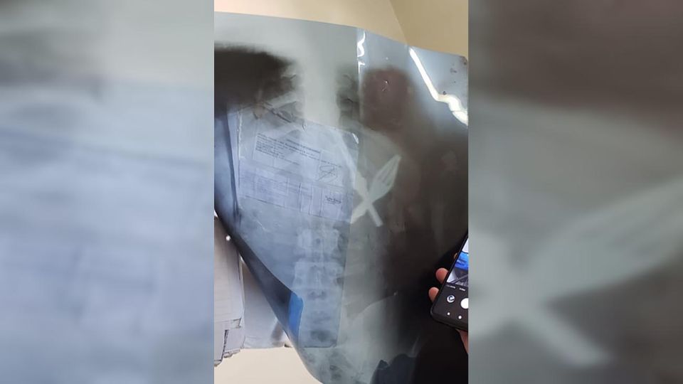 Radiografía que muestra los elementos.