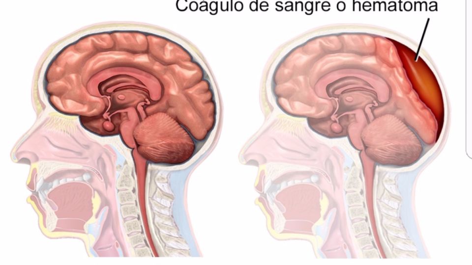 En personas que toman anticoagulantes el riesgo de hematoma es mayor