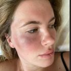 Ireland Basinger Baldwin golpeada