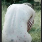 Leann Rimes psoriasis