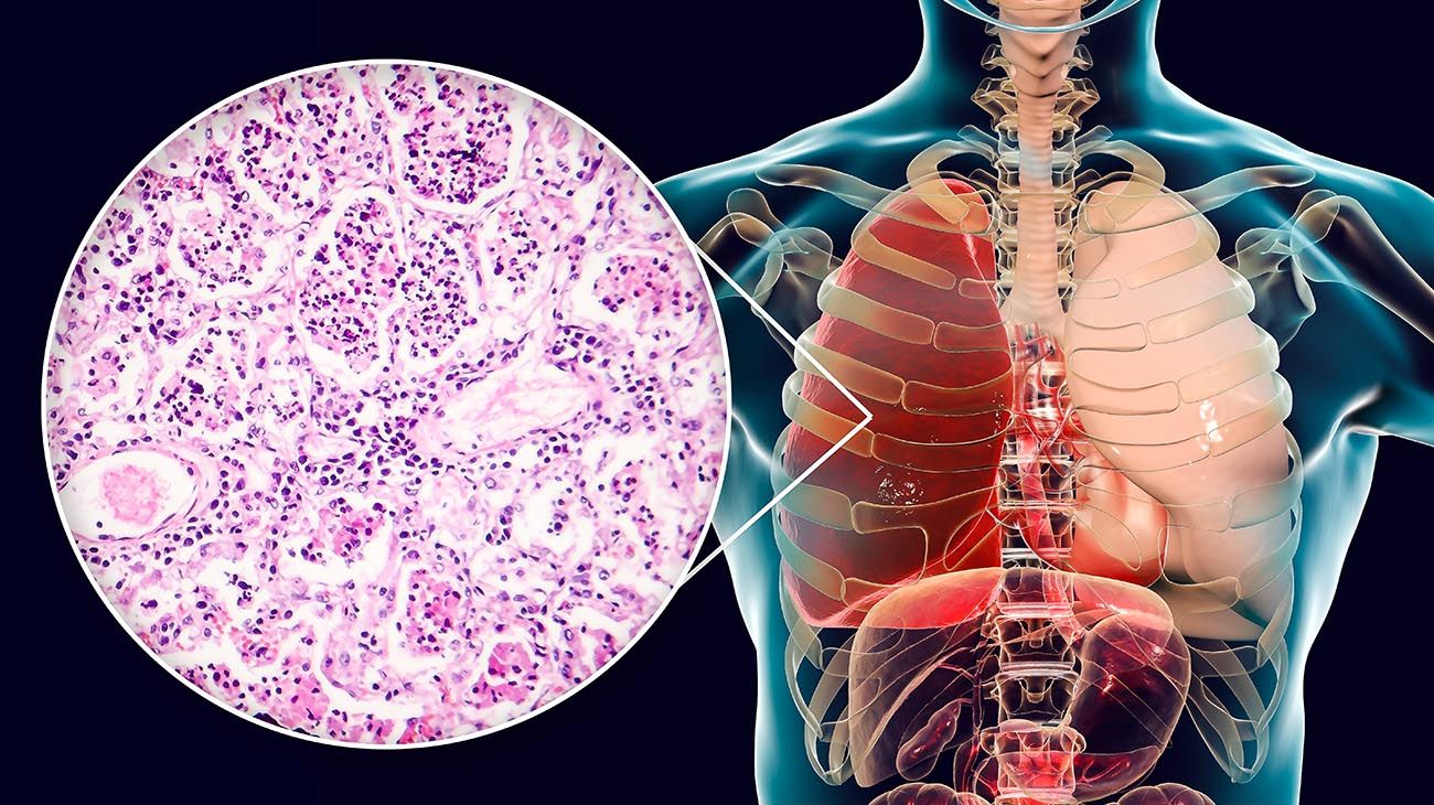 Klebsiella pneumoniae y Esterichia Colis