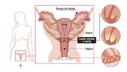 Cáncer de cuello de útero