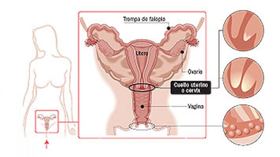 Cáncer de cuello de útero
