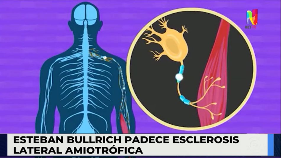 Qué Es La Esclerosis Lateral Amiotrófica (ELA) Y Como Se Diagnostica ...