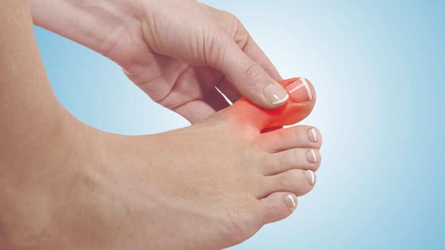 La hiperuricemia puede provocar la aparición de gota, con dolor e inflamación en la articulación.