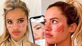 La australiana Tilly Whitfield se pescó una erupción para desnudar los malos consejos dermatológicos de otros influencers.