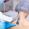 Tratamientos: Los importantes avances en tecnología láser permiten que hoy exista la posibilidad de borrar un tatuaje sin dejar cicatrices. 