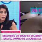 Delfina Gerez Bosco reveló que fue operada de un tumor de 750 gramos en el abdomen 