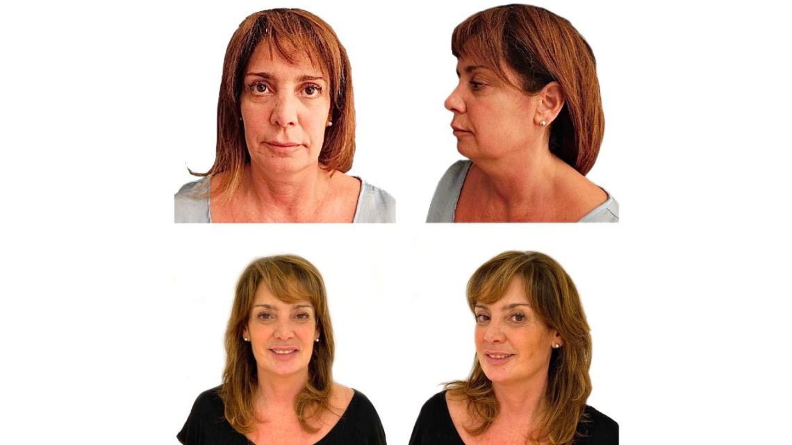 Centro Médico List: tratamientos del tercio inferior del rostro | Caras
