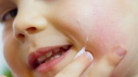 La dermatitis atópica tiene tratamiento, es importante consultar con un dermatólogo