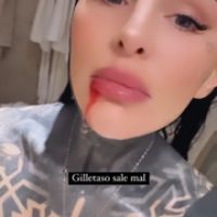 Cande Tinelli apareció con su cara ensangrentada tras un accidente doméstico