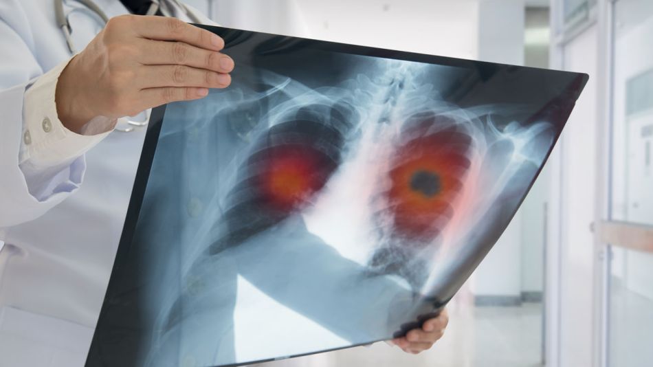 dia de la lucha contra el cancer de pulmon 20211117