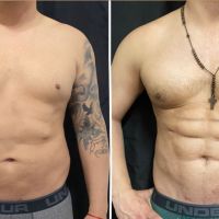 Valentín Fernández Arce: Lipoescultura de Alta Definición con Tecnología